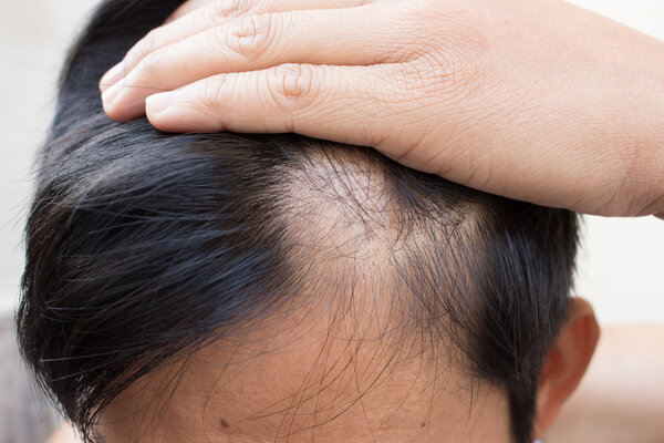 宋亚轩凡尔赛式脱发是什么？雄激素性脱发的原因