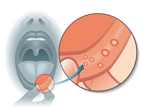 牙龈发炎肿痛怎么消炎最快？牙龈发炎肿痛的治疗方法