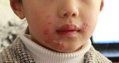宝宝出疱疹有哪些症状？宝宝出疱疹的症状表现